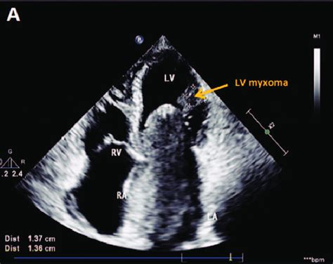 lv myxoma|myxoma vs vegetation.